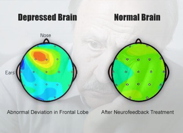 Symptoms of Depression